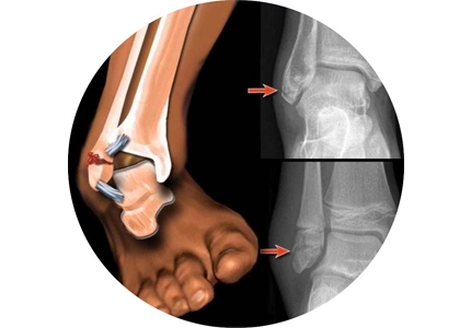 Immobilisation de fracture